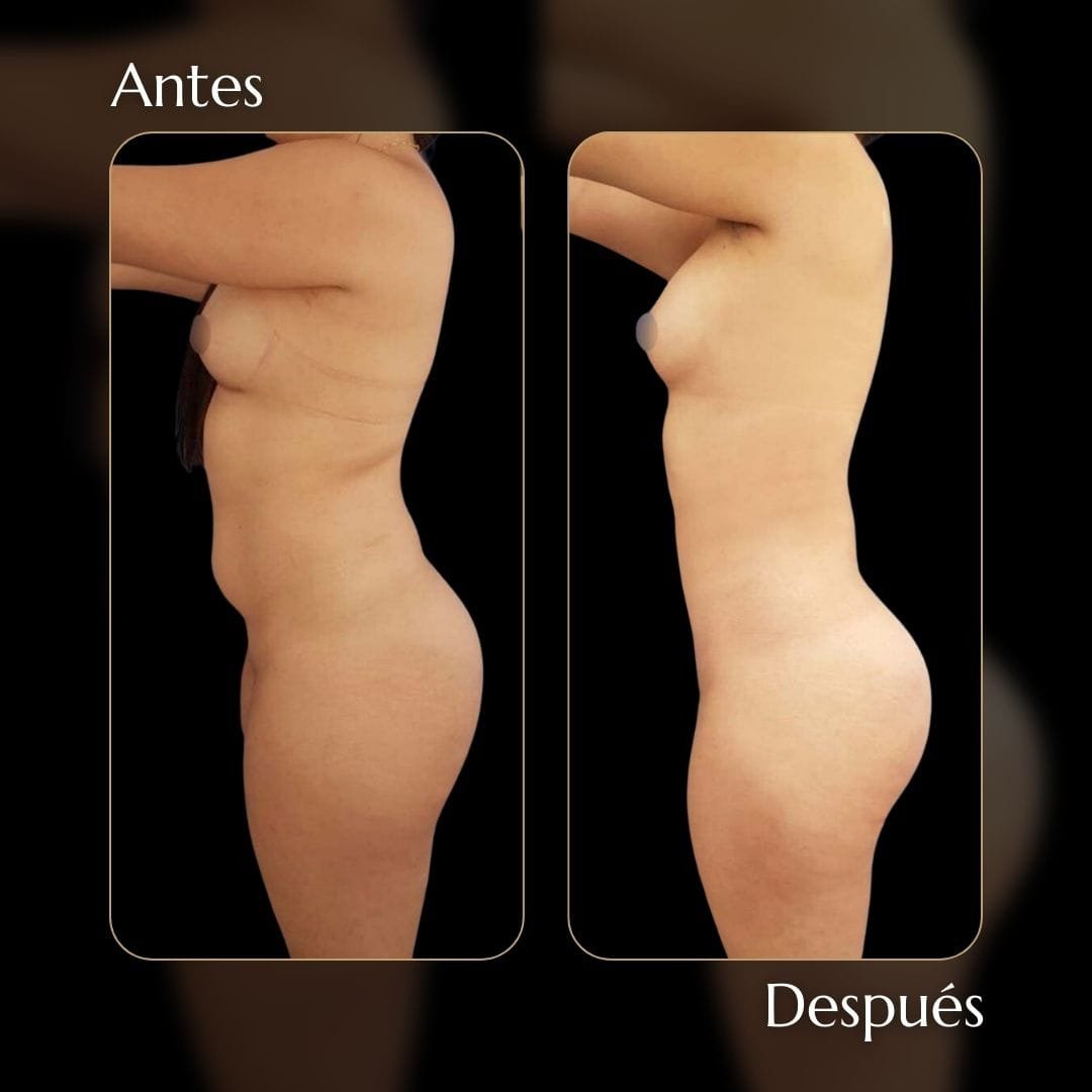 Liposucción