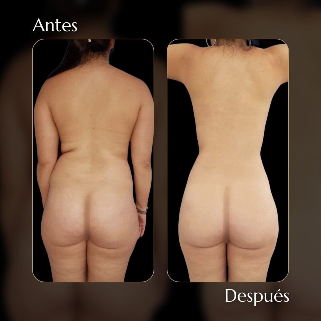Liposucción