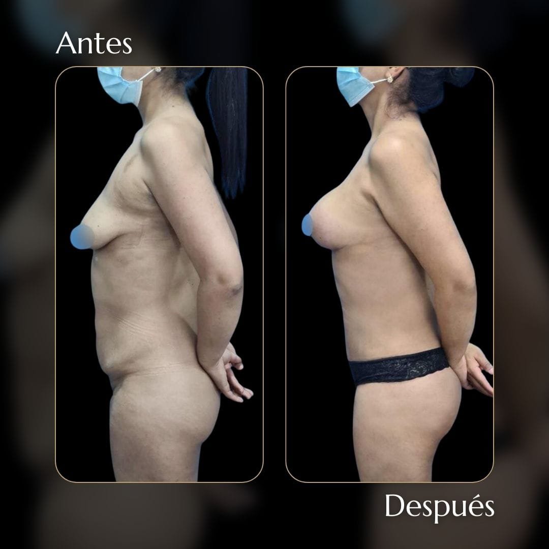 Liposucción