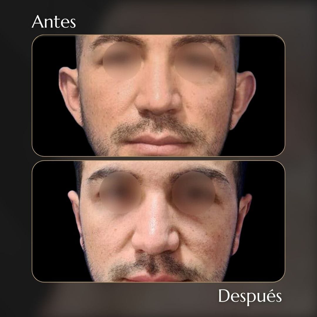 Otoplastia