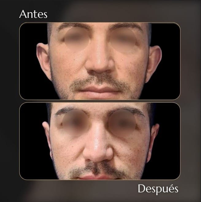 Otoplastia