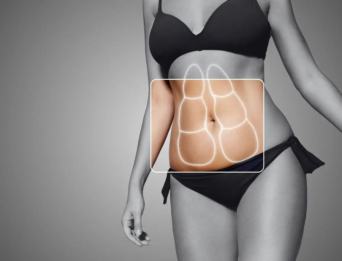 Abdominoplastia en Bogotá - Dr Oscar Baron Cirujano Plastico Bogotá