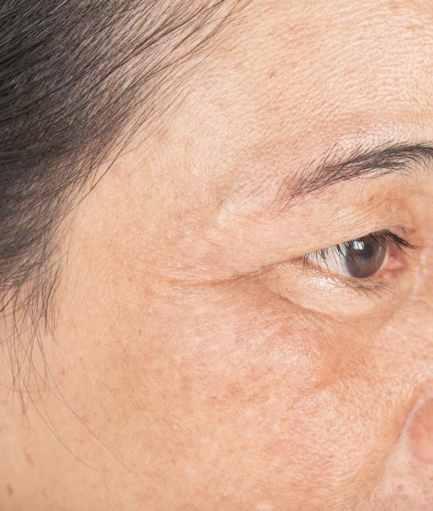 Accutite antes y después - antes - Dr. Óscar Barón - imagen de referencia