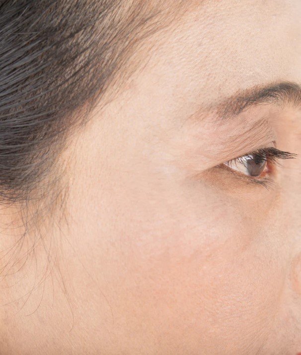Accutite antes y después - después - Dr. Óscar Barón - imagen de referencia