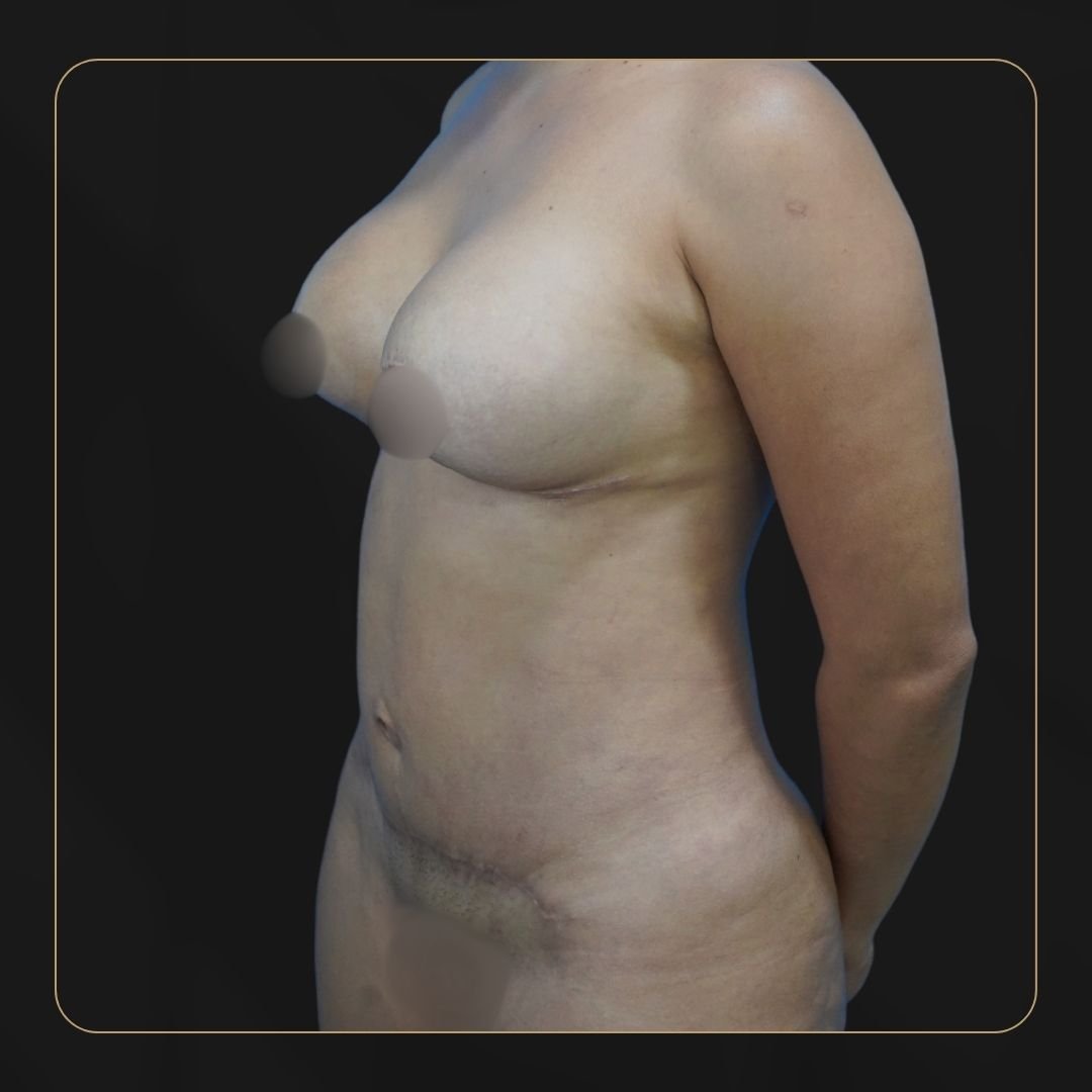Liposucción antes - Dr. Óscar Barón