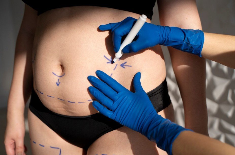 Mommy Makeover en Bogotá- Dr. Óscar Barón- Cirujano plástico en Bogotá