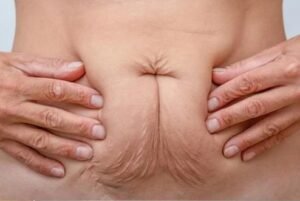 Mujer con abdomen flácido después de un embarazo - Abdominoplastia en Bogotá - Dr. Óscar Barón - Mommy makeover