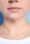 Tratamiento de facetite - Lipo papada antes y después - Antes - Dr. Óscar Barón - Imagen de referencia