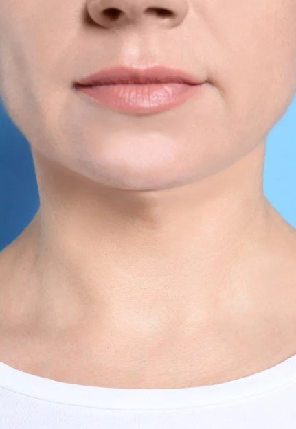 Tratamiento de facetite - Lipo papada antes y después - Antes - Dr. Óscar Barón - Imagen de referencia