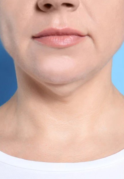 Tratamiento de facetite - Lipo papada antes y después - Después- Dr. Óscar Barón - Imagen de referencia