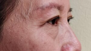 Tratamiento para las bolsas en los ojos - Dr. Óscar Barón - cirujano plástico en Bogotá