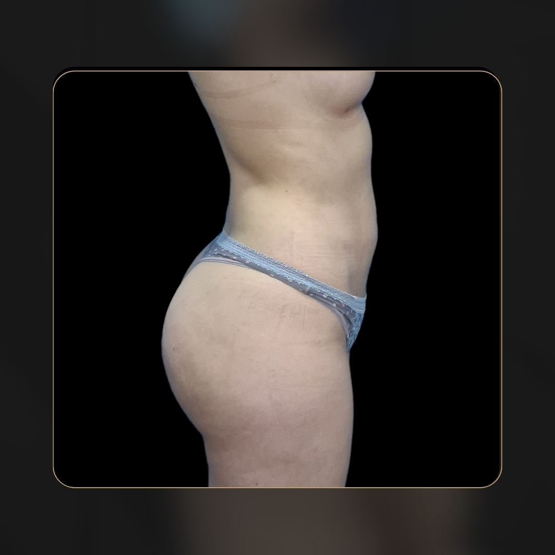 Brazilian butt lift antes y después - Dr. Óscar Barón cirujano plástico en Bogotá - Antes