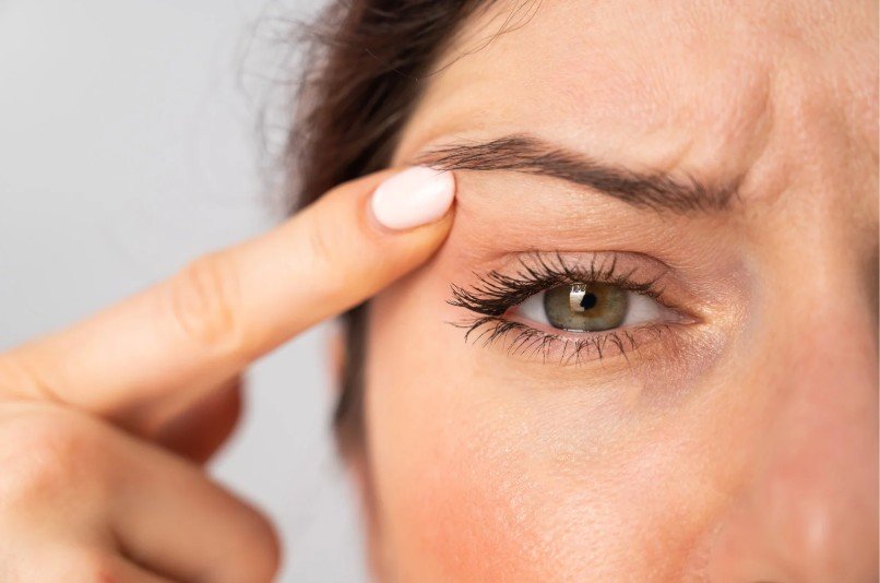 Blefaroplastia en Bogotá- Dr. Oscar Barón