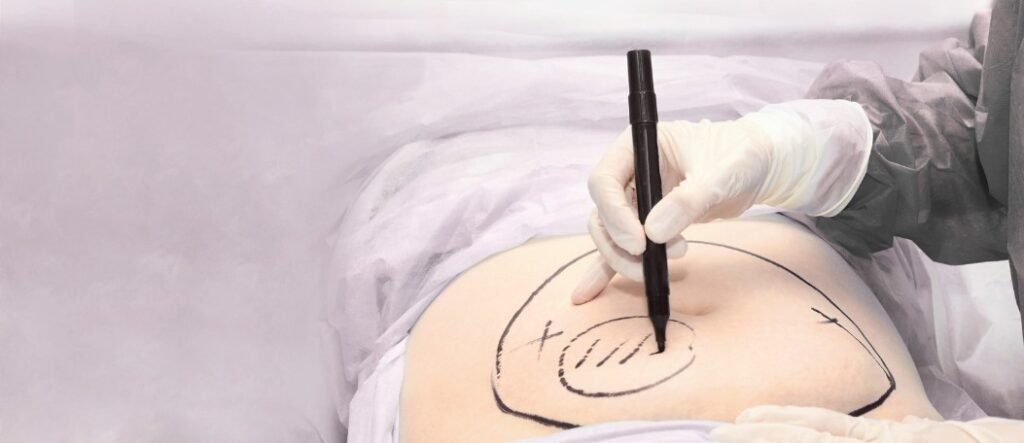 Lipo vaser en Bogotá con el Dr. Óscar Barón