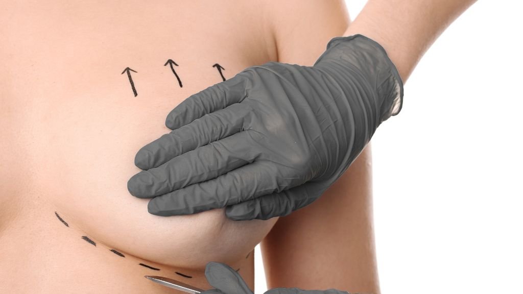 Mastopexia en Madrid o en Bogotá - Dr. Óscar Barón