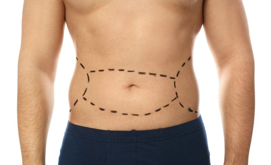 Liposucción para hombres en Madrid o en Bogotá - Cirujano plástico Óscar Barón