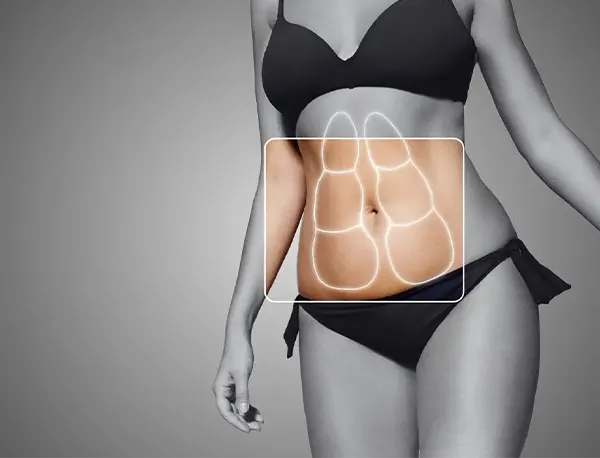 Img-cirujano-plastico-en-bogota-Procedimiento-Abdominoplastia