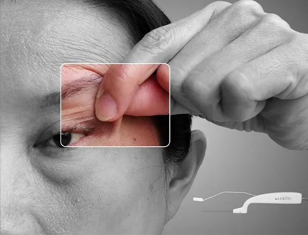 Img-cirujano-plastico-en-bogota-Procedimiento-Accutite