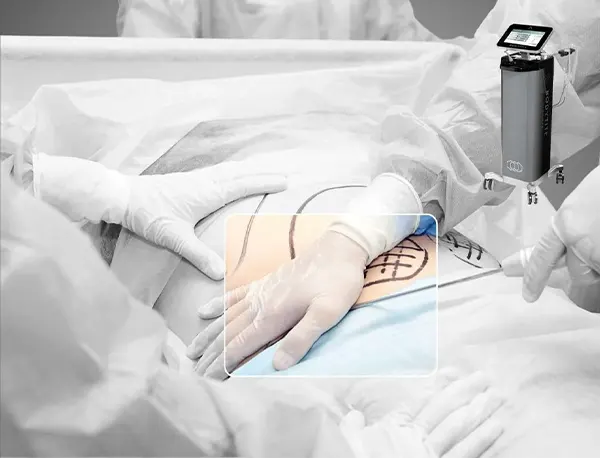 Img-cirujano-plastico-en-bogota-Procedimiento-Bodytite