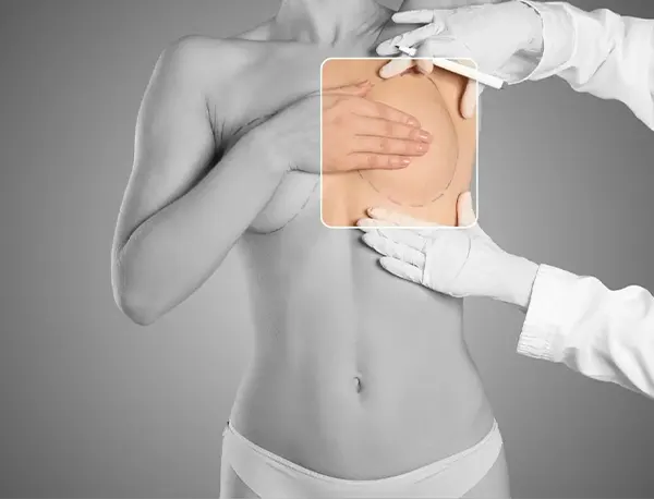 Img-cirujano-plastico-en-bogota-Procedimiento-Explantacion