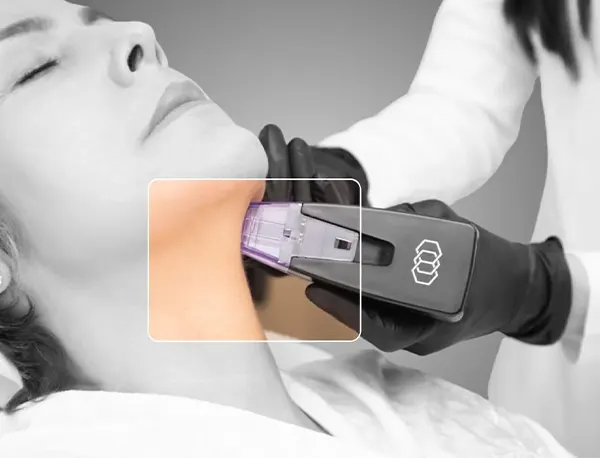 Img-cirujano-plastico-en-bogota-Procedimiento-Morpheus8