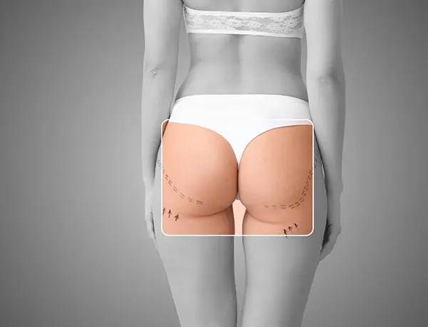 Img-Dr_Oscar_Iván_Barón-Procedimiento-Brazilian-Butt-Lift