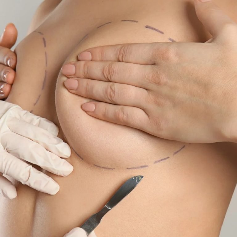 Explantación mamaria qué es- Dr. Oscar Barón