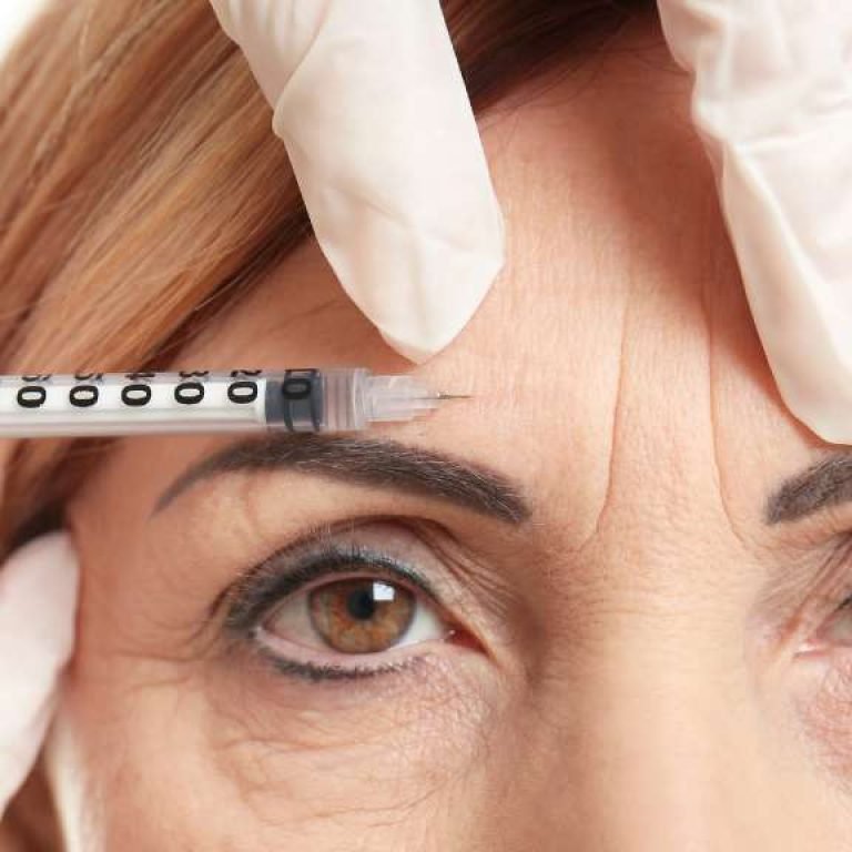 Aplicación de Botox en Bogotá - Dr. Óscar Barón