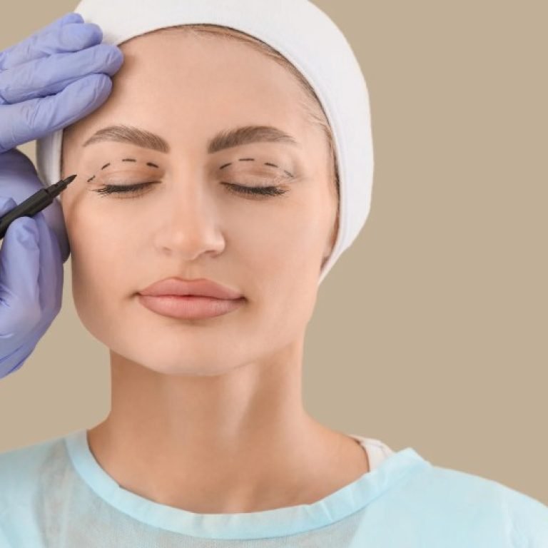 Blefaroplastia antes y después-Dr. Oscar Barón