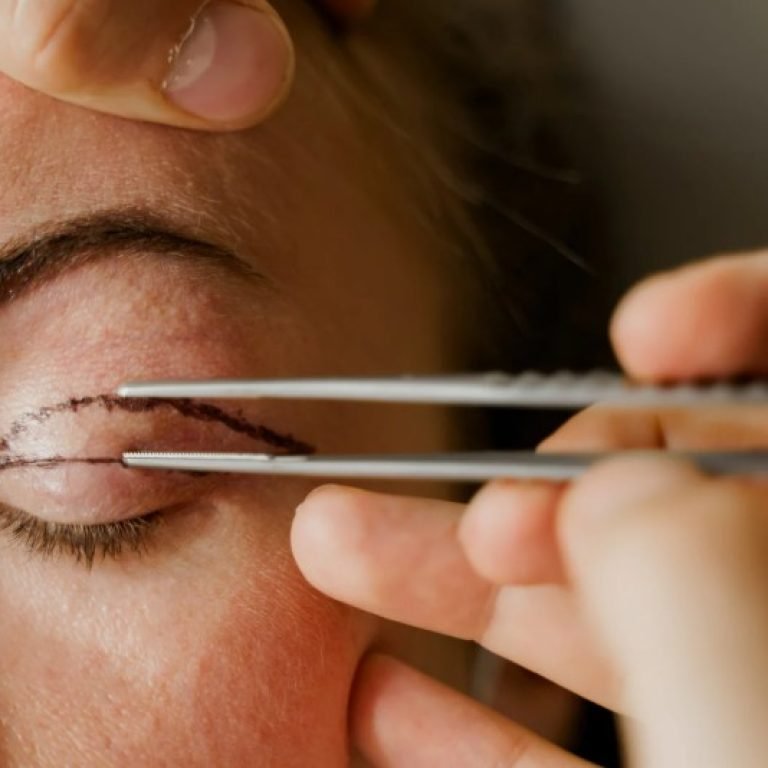 Blefaroplastia en Bogotá- Dr. Oscar Barón