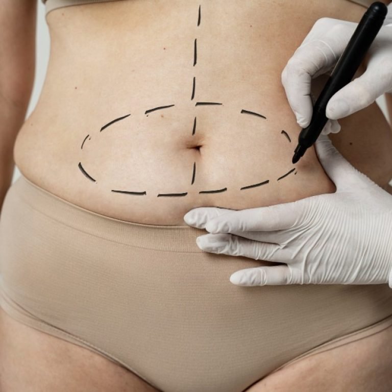 Cuál es el precio de una abdominoplastia en Colombia con el dr. óscar Barón