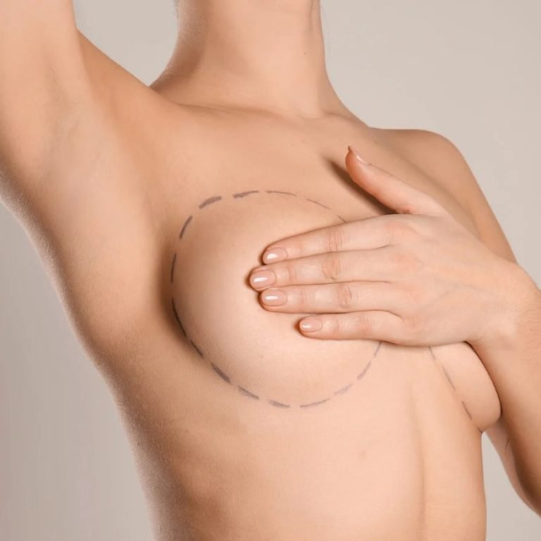 Explantación mamaria en Bogota- Dr. Oscar Barón