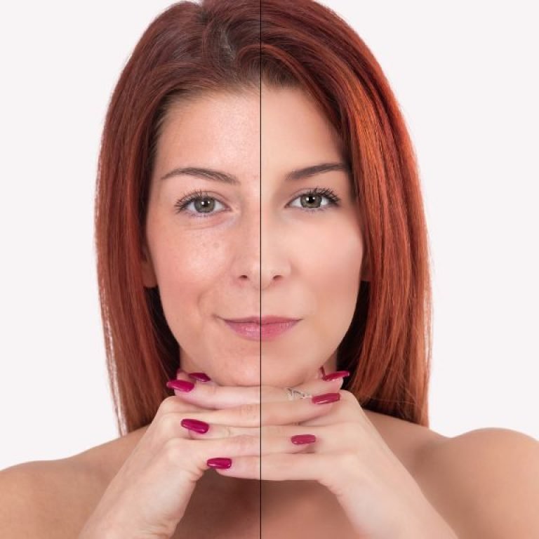 Liftera que es y para que sirve - Dr. Oscar Barón