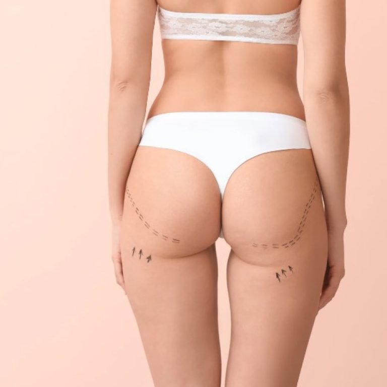 Lipotransferencia glútea- Dr. Oscar Barón- Cirujano Plástico en Bogotá