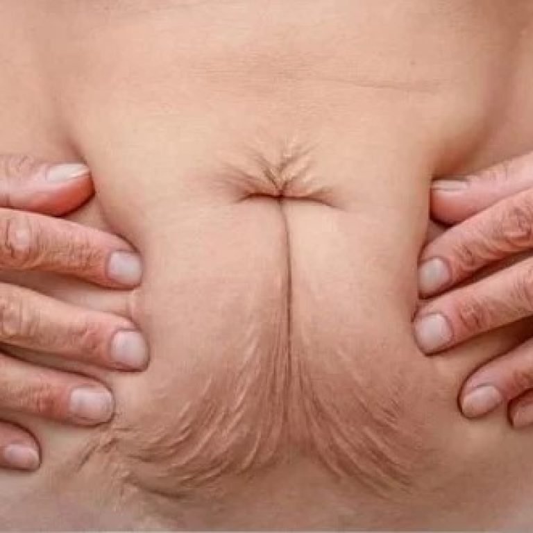 Mommy Makeover en Bogotá- Dr. Óscar Barón- Cirujano plástico en Bogotá