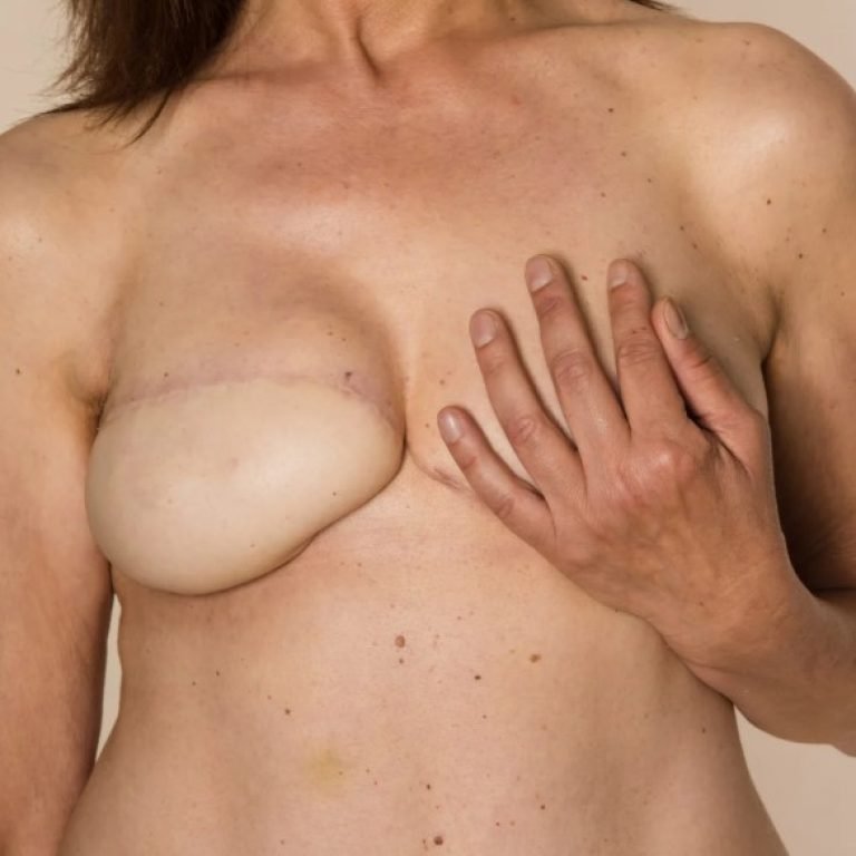 Reconstrucción de senos sin implantes - Cirujano plástico en Bogotá Colombia Óscar Barón