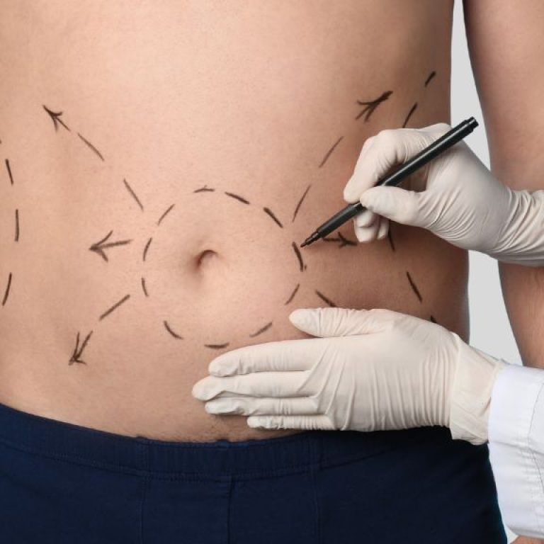 Tummy tuck precio - Cirujano plástico en Bogotá Óscar Barón