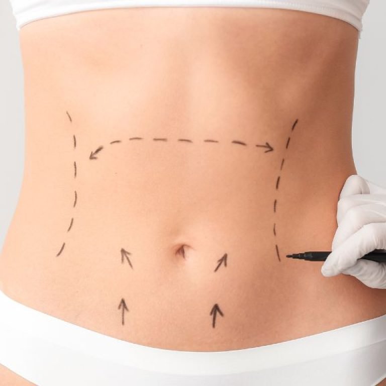 Tummy tuck qué es - cirujano plástico en Bogotá óscar barón